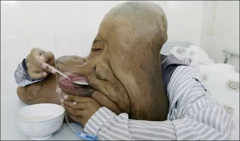 Хуанг Чункай — Китайский мужчина с огромной опухолью на лице